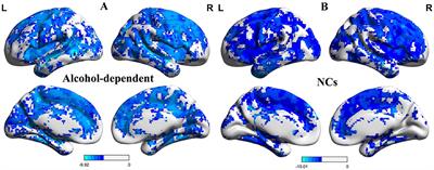 Alcohol-induced brain deficit in alcohol dependence